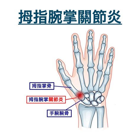 大拇指指節|手部骨關節炎 